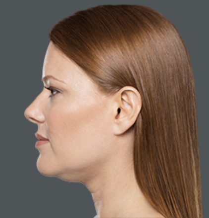 Kybella Before